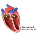  Cardiac Arrythemias